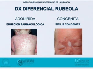 INFECCIONES VIRALES SISTÉMICAS DE LA INFANCIA



    DX DIFERENCIAL RUBEOLA

     ADQUIRIDA                           CONGENITA
ERUPCIÓN FARMACOLÓGICA                  SÍFILIS CONGÉNITA
 