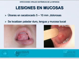 INFECCIONES VIRALES SISTÉMICAS DE LA INFANCIA



          LESIONES EN MUCOSAS
   Úlceras en sacabocado 5 – 10 mm ,dolorosas

   Se localizan paladar duro, lengua y mucosa bucal
 