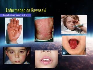 Enfermedad de Kawasaki
Manifestaciones clínica
 