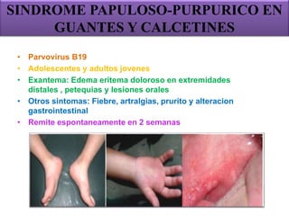 SINDROME PAPULOSO-PURPURICO EN
GUANTES Y CALCETINES
• Parvovirus B19
• Adolescentes y adultos jovenes
• Exantema: Edema eritema doloroso en extremidades
distales , petequias y lesiones orales
• Otros sintomas: Fiebre, artralgias, prurito y alteracion
gastrointestinal
• Remite espontaneamente en 2 semanas
 