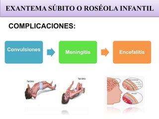 COMPLICACIONES:
Convulsiones
Meningitis Encefalitis
EXANTEMA SÚBITO O ROSÉOLA INFANTIL
 