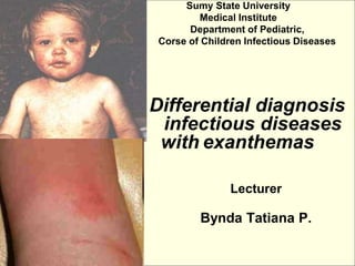 Sumy State University
Medical Institute
Department of Pediatric,
Corse of Children Infectious Diseases
Differential diagnosis
infectious diseases
with exanthemas
Lecturer
Bynda Tatiana P.
 
