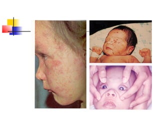 Exanthematous Fever-fever with rash1.pptx