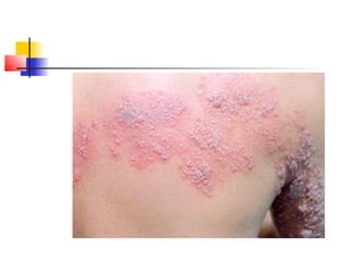 Exanthematous Fever-fever with rash1.pptx