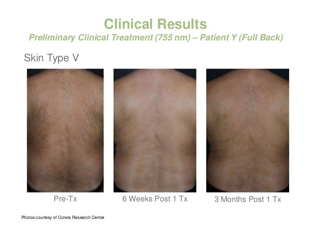 Laser Hair Removal And Vascular Treatment With Excell Hr Laser