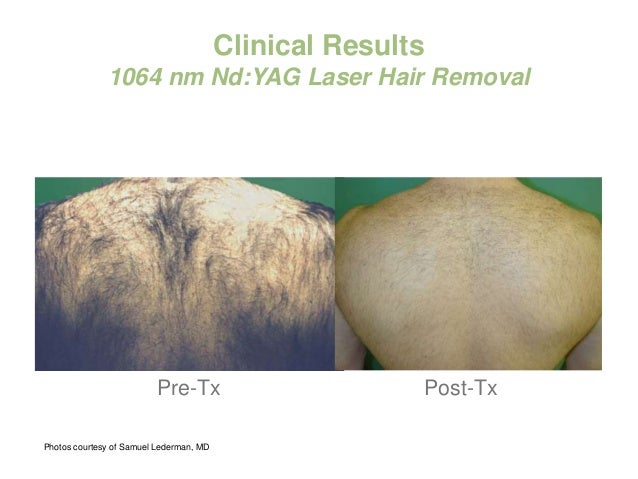 Laser Hair Removal And Vascular Treatment With Excell Hr Laser