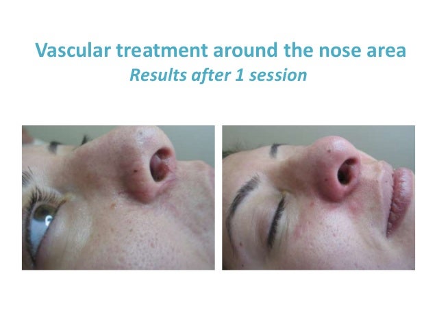 Laser Hair Removal And Vascular Treatment With Excell Hr Laser
