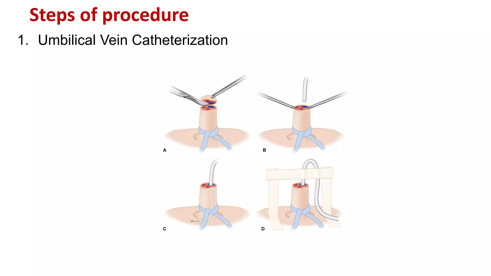 Steps of procedure
1. Umbilical Vein Catheterization
 