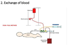 2. Exchange of blood
PUSH- PULL METHOD
 