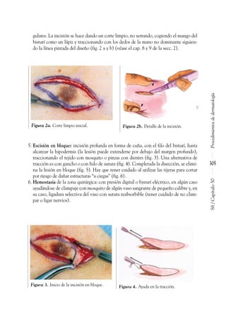gulares. La incisión se hace dando un corte limpio, no serrando, cogiendo el mango del
bisturí como un lápiz y traccionando con los dedos de la mano no dominante siguien-
do la línea pintada del diseño (fig. 2 a y b) (véase el cap. 8 y 9 de la secc. 2).
5. Escisión en bloque: incisión profunda en forma de cuña, con el filo del bisturí, hasta
alcanzar la hipodermis (la lesión puede extenderse por debajo del margen profundo),
traccionando el tejido con mosquito o pinzas con dientes (fig. 3). Una alternativa de
tracción es con gancho o con hilo de sutura (fig. 4). Completada la disección, se elimi-
na la lesión en bloque (fig. 5). Hay que tener cuidado al utilizar las tijeras para cortar
por riesgo de dañar estructuras “a ciegas” (fig. 6).
6. Hemostasia de la zona quirúrgica: con presión digital o bisturí eléctrico, en algún caso
ayudándose de clampaje con mosquito de algún vaso sangrante de pequeño calibre y, en
su caso, ligadura selectiva del vaso con sutura reabsorbible (tener cuidado de no clam-
par o ligar nervios).
Procedimientos
de
dermatología
S8
/
Capítulo
50
305
Figura 2a. Corte limpio inicial.
Figura 3. Inicio de la incisión en bloque.
Figura 2b. Detalle de la incisión.
Figura 4. Ayuda en la tracción.
 