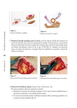 7. Preparar la herida quirúrgica para el cierre: se ha de valorar el grado de resistencia al
cierre de la herida, para evitar la isquemia de los bordes. Si fuese preciso, se practicará
disección subcutánea de todo el margen de la herida: disección de la unión dermo-grasa
con bisturí inicialmente (véase el cap. 8, pp. 57-58) (fig. 7) y después con disección
roma con tijeras de disección o mosquito (fig. 8) ayudándose con gancho o pinzas de
Adson con dientes.
8. Sutura de la herida por planos (véase el cap. 10 de la secc. 2):
El cierre por planos ofrece las siguientes ventajas:
–– Disminuye la tensión de la herida quirúrgica, con lo que la sutura superficial que se
necesita será más fina y el resultado estético mejor.
–– Se evita la creación de seromas al obliterar el espacio libre virtual que quedaría si no
se realiza el cierre profundo (fig. 9).
Procedimientos
de
dermatología
S8
/
Capítulo
50
306
Figura 5
Escisión en bloque completa.
Figura 6
Riesgo de escisión “a ciegas”.
Figura 7
Disección de la unión dermo-grasa con bisturí.
Figura 8
Disección de la unión dermo-grasa con tijeras.
2 mm
 