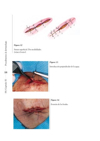 Procedimientos
de
dermatología
S8
/
Capítulo
50
308
Figura 14
Eversión de los bordes.
Figura 12
Sutura superficial. Dos modalidades.
(véase el texto)
1
2 4
2
3
3
5
1
Figura 13
Introducción perpendicular de la aguja.
 