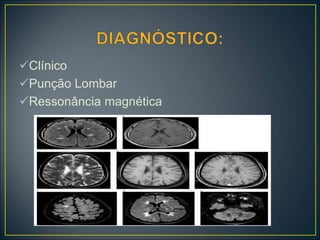 Clínico
Punção Lombar
Ressonância magnética
 