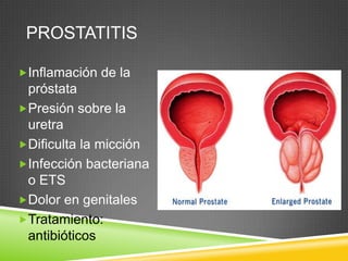 PROSTATITIS

Inflamación de la
 próstata
Presión sobre la
 uretra
Dificulta la micción
Infección bacteriana
 o ETS
Dolor en genitales
Tratamiento:
 antibióticos
 