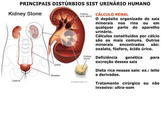 PRINCIPAIS DISTÚRBIOS SIST URINÁRIO HUMANO
CÁLCULO RENAL
O depósito organizado de sais
minerais nos rins ou em
qualquer parte do aparelho
urinário.
Cálculos constituídos por cálcio
são os mais comuns. Outros
minerais encontrados são:
oxalato, fósforo, ácido úrico.
Deficiência genética para
excreção desses sais
Dieta rica nessas sais: ex.: leite
e derivados.
Tratamento cirúrgico ou não
invasivo: ultra-som
 