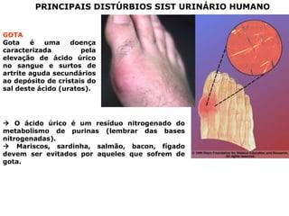 PRINCIPAIS DISTÚRBIOS SIST URINÁRIO HUMANO
GOTA
Gota é uma doença
caracterizada pela
elevação de ácido úrico
no sangue e surtos de
artrite aguda secundários
ao depósito de cristais do
sal deste ácido (uratos).
 O ácido úrico é um resíduo nitrogenado do
metabolismo de purinas (lembrar das bases
nitrogenadas).
 Mariscos, sardinha, salmão, bacon, fígado
devem ser evitados por aqueles que sofrem de
gota.
 