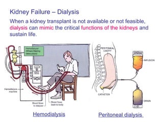 Kidney Failure – Dialysis
When a kidney transplant is not available or not feasible,
dialysis can mimic the critical functions of the kidneys and
sustain life.
Peritoneal dialysisHemodialysis
 