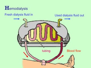 Hemodialysis
Fresh dialysis fluid in Used dialysis fluid out
Blood flowtubing
 