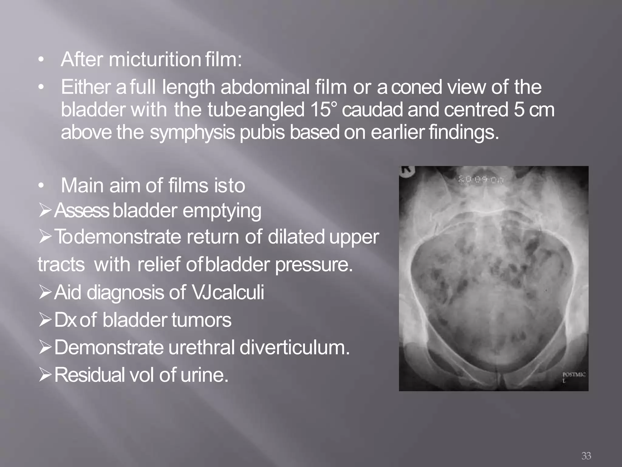 • After micturitionfilm:
• Either afull length abdominal film or aconed view of the
bladder with the tubeangled 15° caudad and centred 5 cm
above the symphysis pubis based on earlier findings.
• Main aim of films isto
Assessbladder emptying
Todemonstrate return of dilatedupper
tracts with relief ofbladder pressure.
Aid diagnosis of VJcalculi
Dxof bladder tumors
Demonstrate urethral diverticulum.
Residual vol of urine.
33
 