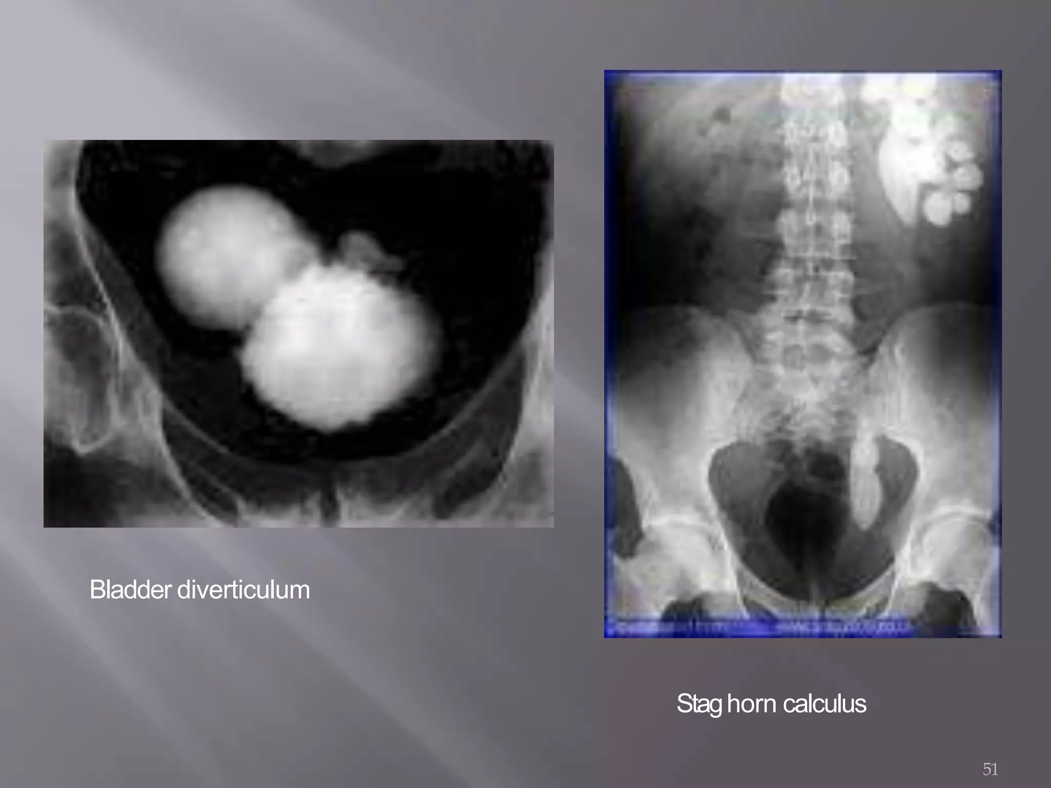 Bladder diverticulum
51
Staghorn calculus
 
