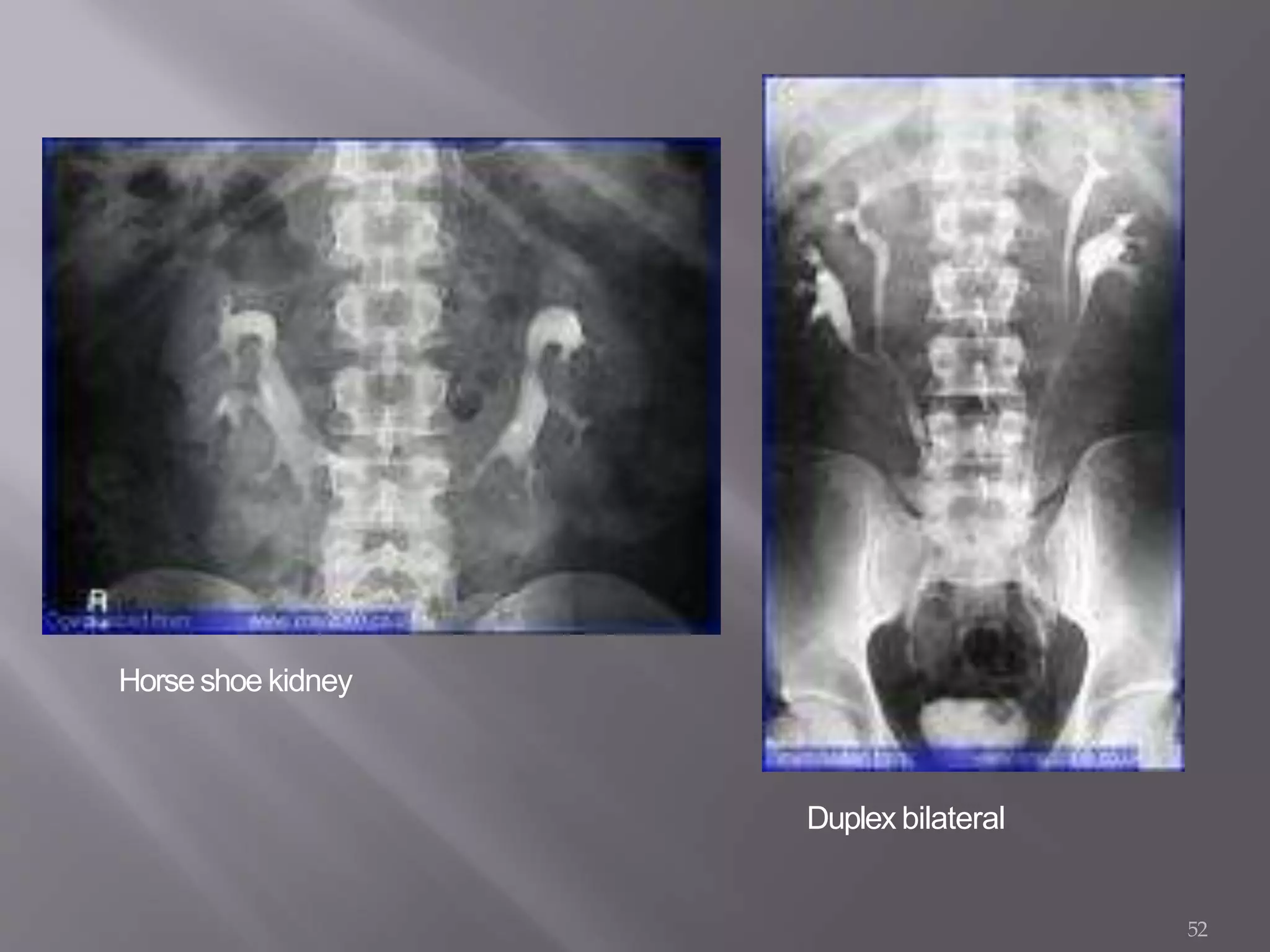 Horseshoe kidney
52
Duplex bilateral
 