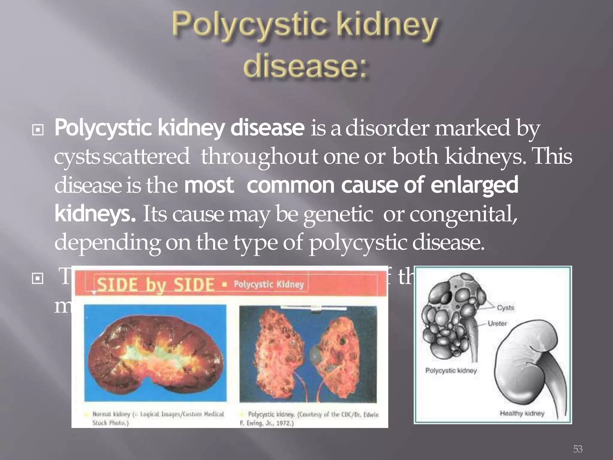  Polycystic kidney disease is adisorder marked by
cystsscattered throughout one or both kidneys. This
diseaseis the most common cause of enlarged
kidneys. Its causemaybe genetic or congenital,
depending on the type of polycystic disease.
 Thesecystsalter the appearanceof the kidneyand
mayalter renal function.
53
 
