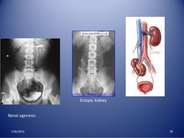 Excretion Urography / Intravenous Urography (IVU)
