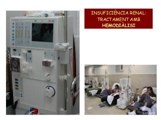 INSUFICIÈNCIA RENAL:
TRACTAMENT AMB
HEMODIÀLISI

 