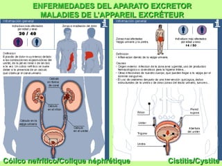 ENFERMEDADES DEL APARATO EXCRETOR
          MALADIES DE L’APPAREIL EXCRÉTEUR




Cólico nefrítico/Colique néphrétique   Cistitis/Cystite
 