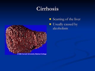 Cirrhosis Scarring of the liver Usually caused by alcoholism 