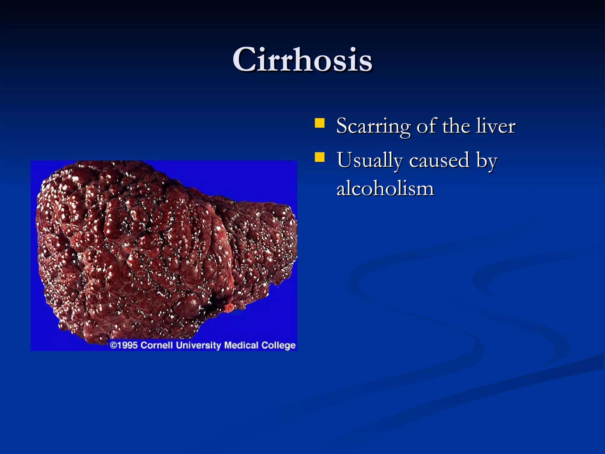 Cirrhosis Scarring of the liver Usually caused by alcoholism 