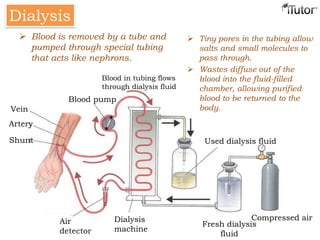  Tiny pores in the tubing allow
salts and small molecules to
pass through.
 Wastes diffuse out of the
blood into the fluid-filled
chamber, allowing purified
blood to be returned to the
body.
Dialysis
Air
detector
Dialysis
machine
Fresh dialysis
fluid
Compressed air
Vein
Artery
Shunt
Blood pump
Blood in tubing flows
through dialysis fluid
Used dialysis fluid
 Blood is removed by a tube and
pumped through special tubing
that acts like nephrons.
 