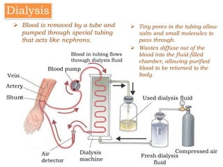  Tiny pores in the tubing allow
salts and small molecules to
pass through.
 Wastes diffuse out of the
blood into the fluid-filled
chamber, allowing purified
blood to be returned to the
body.
Dialysis
Air
detector
Dialysis
machine
Fresh dialysis
fluid
Compressed air
Vein
Artery
Shunt
Blood pump
Used dialysis fluid
 Blood is removed by a tube and
pumped through special tubing
that acts like nephrons.
Blood in tubing flows
through dialysis fluid
 