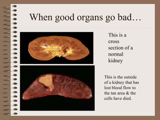 When good organs go bad…
This is a
cross
section of a
normal
kidney
This is the outside
of a kidney that has
lost blood flow to
the tan area & the
cells have died.
 