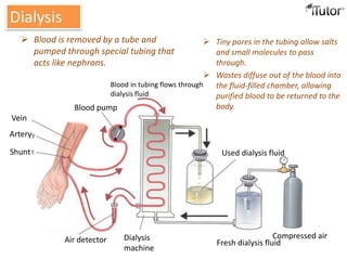  Tiny pores in the tubing allow salts
and small molecules to pass
through.
 Wastes diffuse out of the blood into
the fluid-filled chamber, allowing
purified blood to be returned to the
body.
Dialysis
Air detector Dialysis
machine
Fresh dialysis fluid
Compressed air
Vein
Artery
Shunt
Blood pump
Blood in tubing flows through
dialysis fluid
Used dialysis fluid
 Blood is removed by a tube and
pumped through special tubing that
acts like nephrons.
 