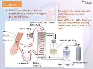  Tiny pores in the tubing allow salts
and small molecules to pass
through.
 Wastes diffuse out of the blood into
the fluid-filled chamber, allowing
purified blood to be returned to the
body.
Dialysis
Air detector Dialysis
machine
Fresh dialysis fluid
Compressed air
Vein
Artery
Shunt
Blood pump
Blood in tubing flows through
dialysis fluid
Used dialysis fluid
 Blood is removed by a tube and
pumped through special tubing that
acts like nephrons.
 