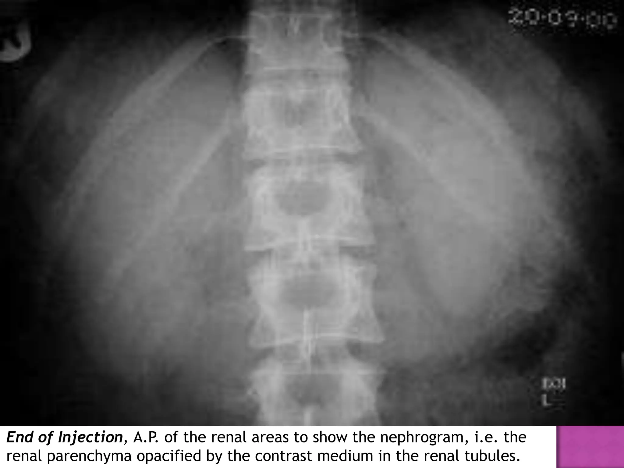 End of Injection, A.P. of the renal areas to show the nephrogram, i.e. the
renal parenchyma opacified by the contrast medium in the renal tubules.
 