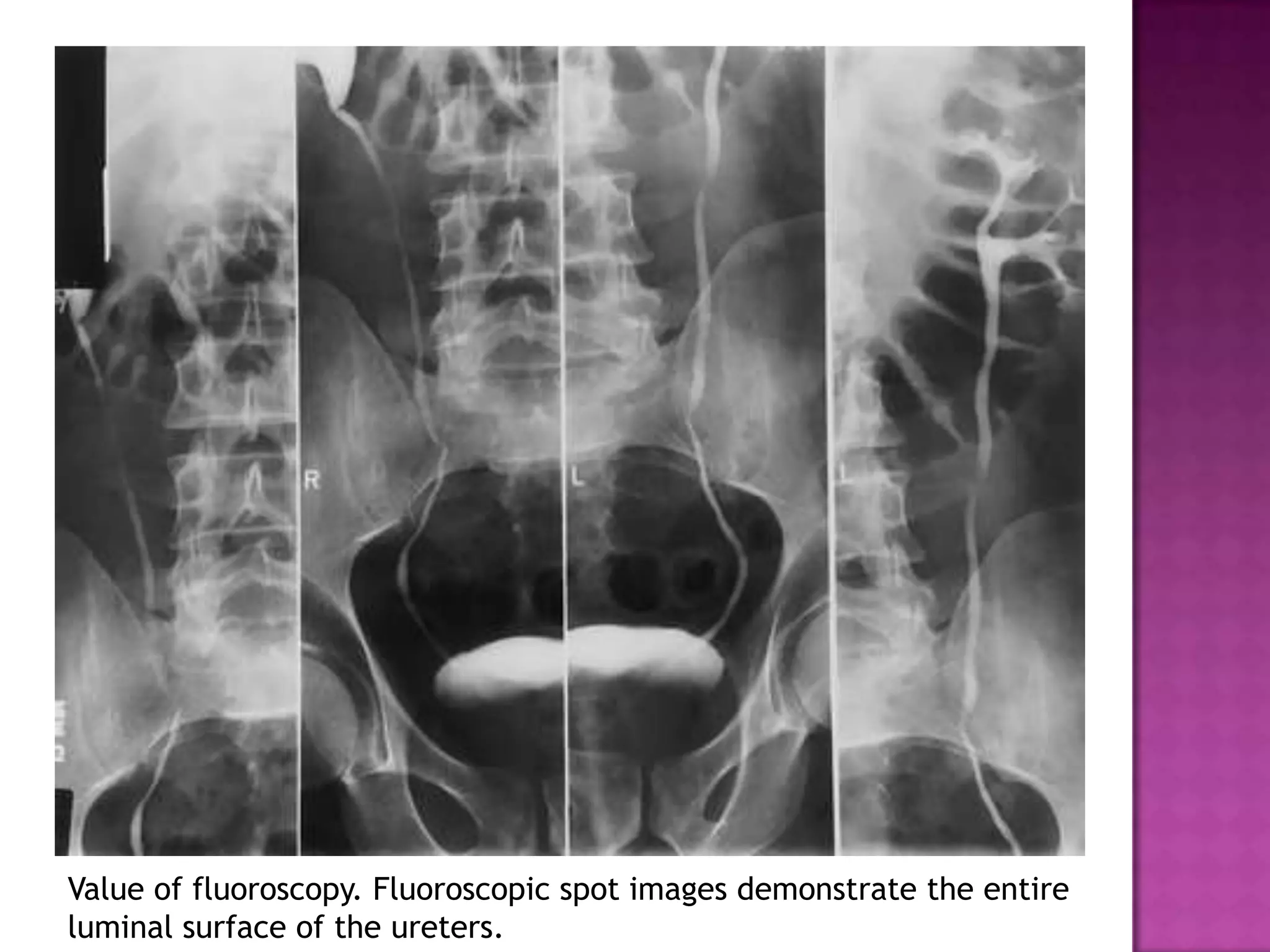 Value of fluoroscopy. Fluoroscopic spot images demonstrate the entire
luminal surface of the ureters.
 