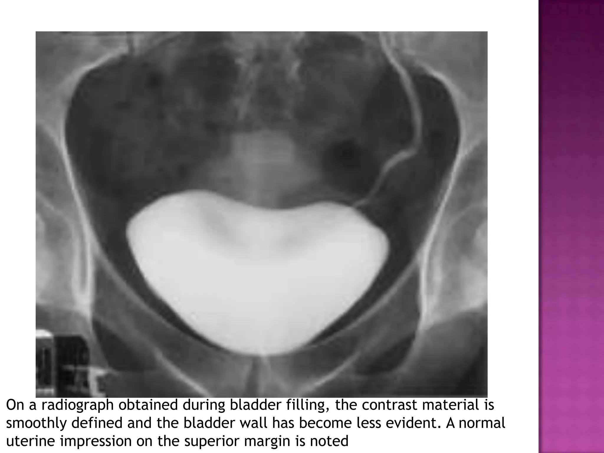 On a radiograph obtained during bladder filling, the contrast material is
smoothly defined and the bladder wall has become less evident. A normal
uterine impression on the superior margin is noted
 