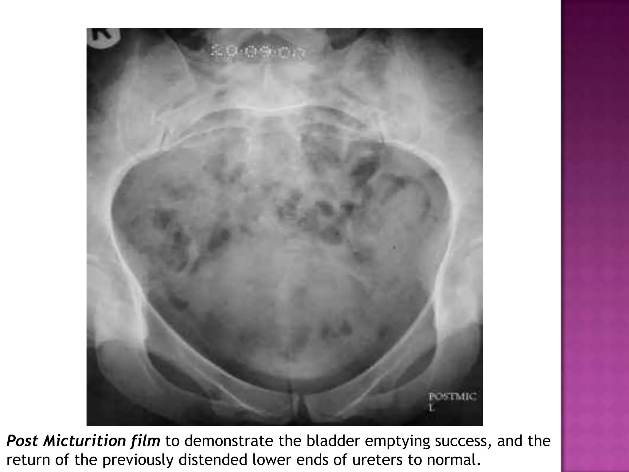 Post Micturition film to demonstrate the bladder emptying success, and the
return of the previously distended lower ends of ureters to normal.
 