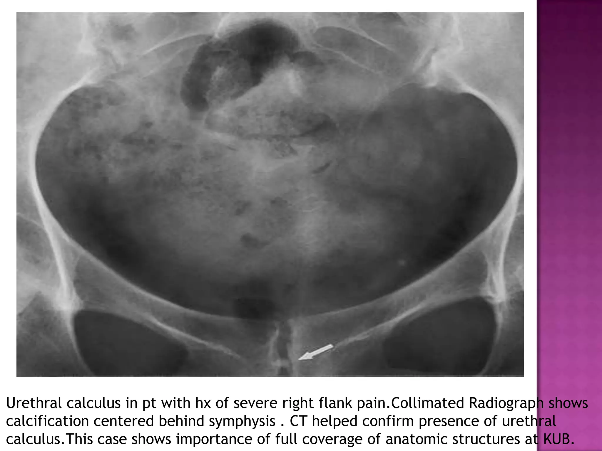 Urethral calculus in pt with hx of severe right flank pain.Collimated Radiograph shows
calcification centered behind symphysis . CT helped confirm presence of urethral
calculus.This case shows importance of full coverage of anatomic structures at KUB.
 