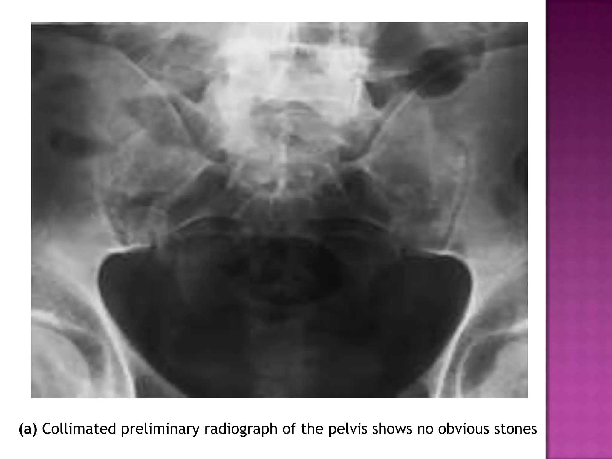 (a) Collimated preliminary radiograph of the pelvis shows no obvious stones
 