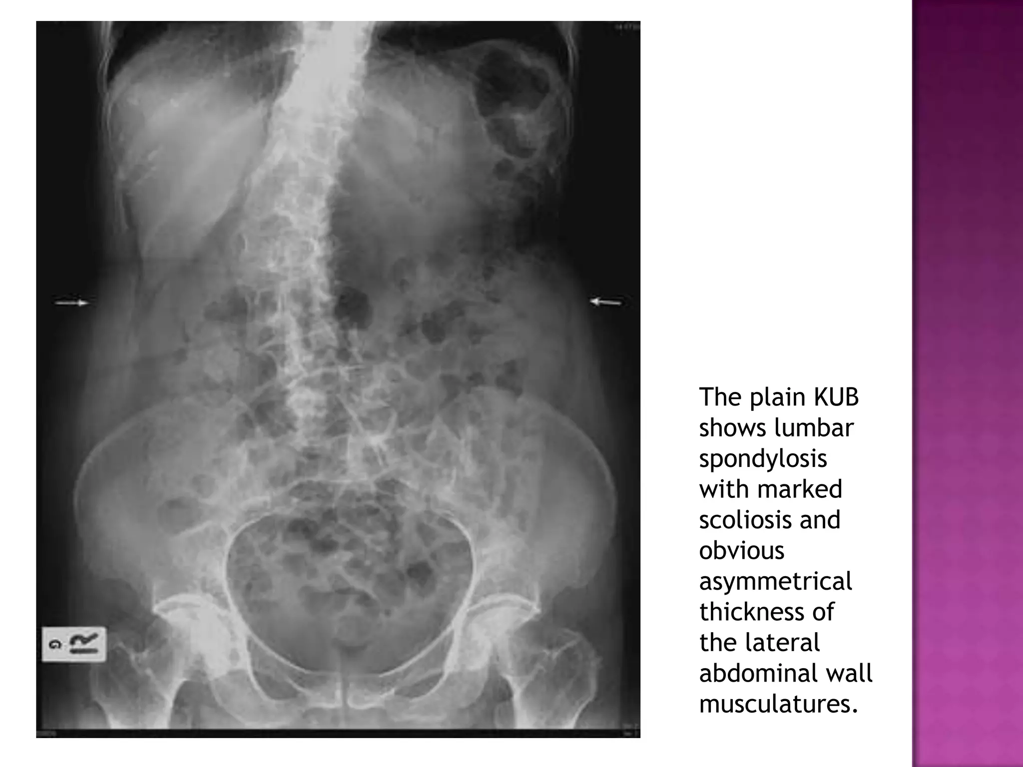 The plain KUB
shows lumbar
spondylosis
with marked
scoliosis and
obvious
asymmetrical
thickness of
the lateral
abdominal wall
musculatures.
 