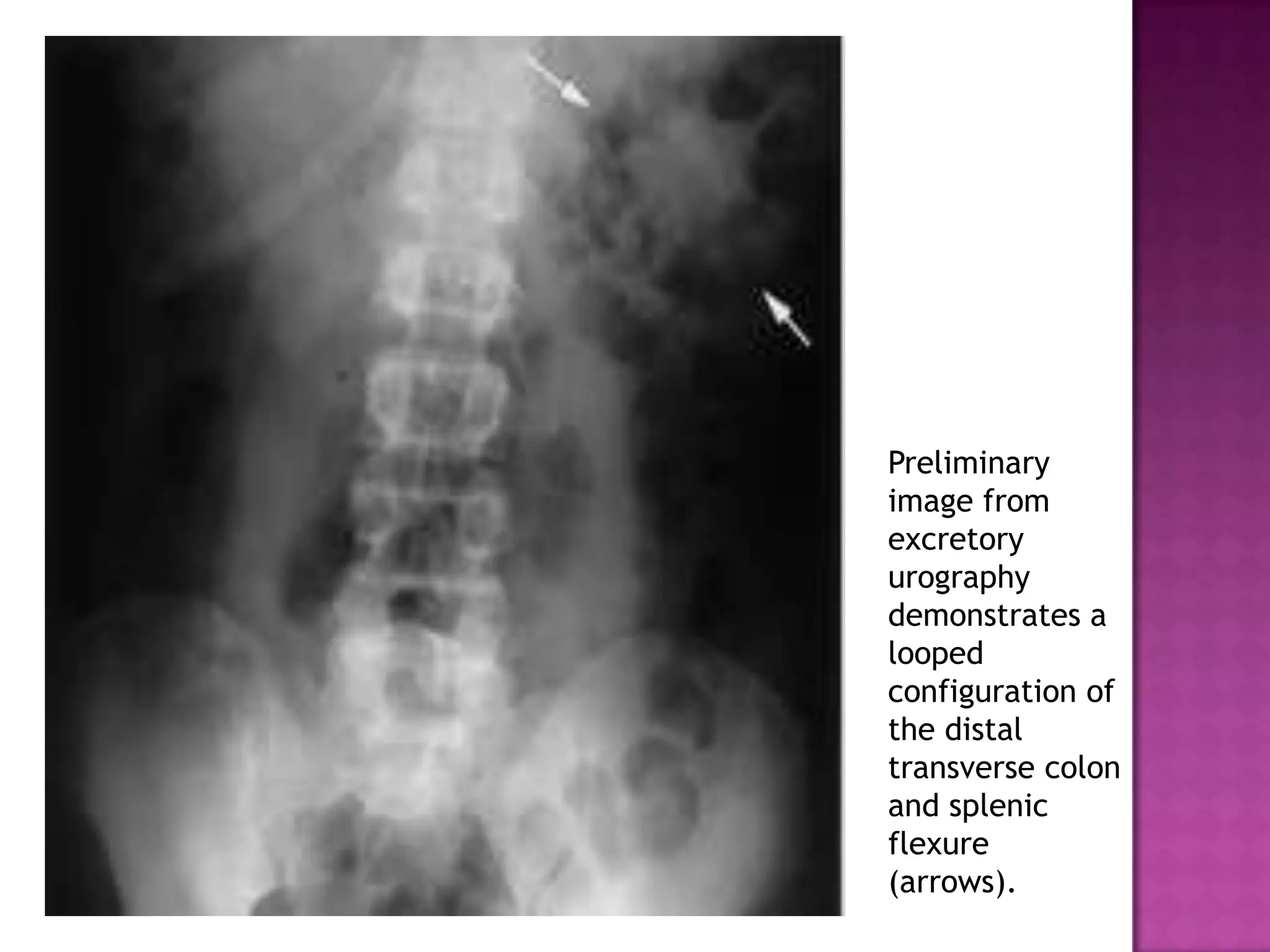 Preliminary
image from
excretory
urography
demonstrates a
looped
configuration of
the distal
transverse colon
and splenic
flexure
(arrows).
 