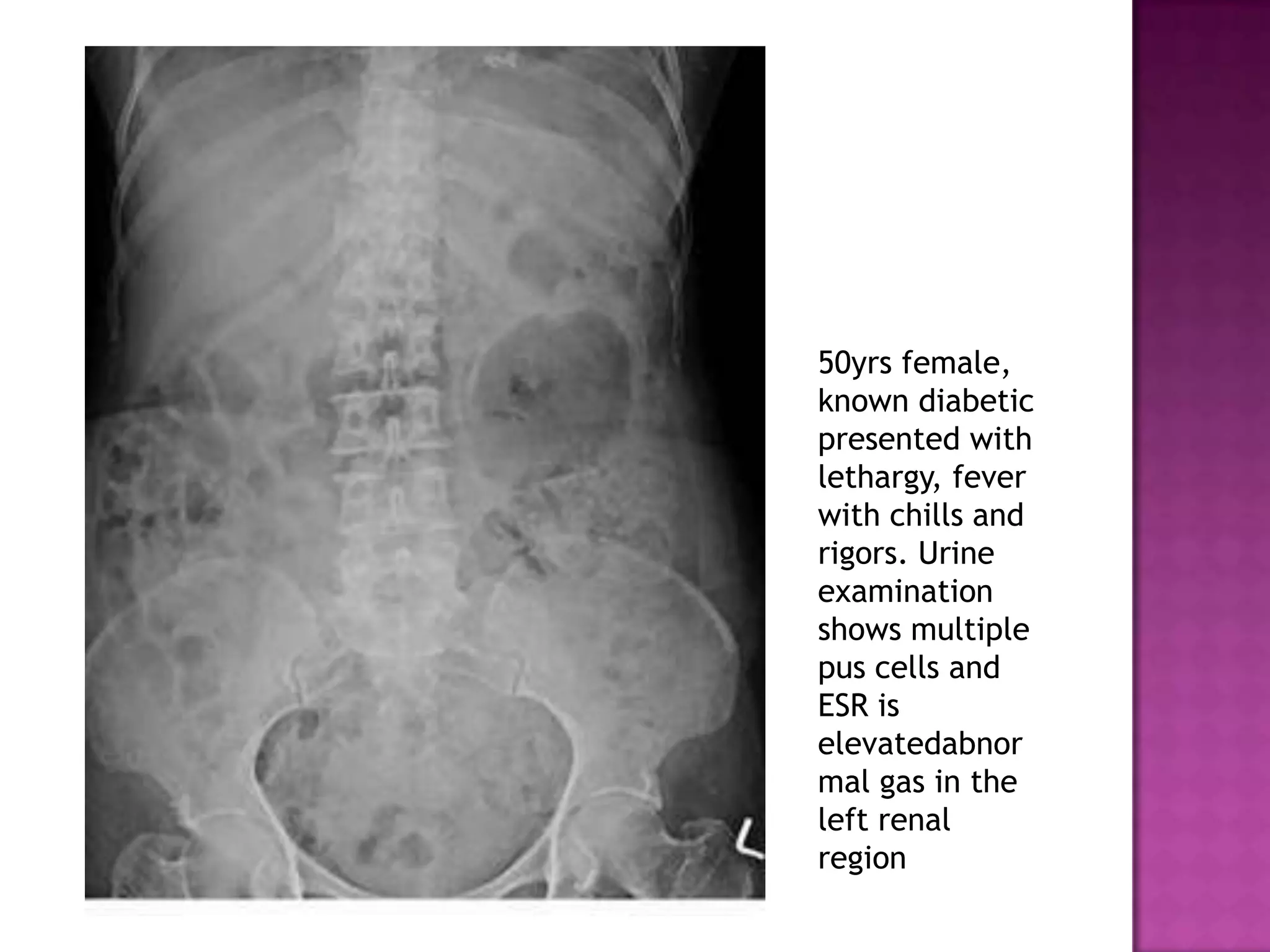 50yrs female,
known diabetic
presented with
lethargy, fever
with chills and
rigors. Urine
examination
shows multiple
pus cells and
ESR is
elevatedabnor
mal gas in the
left renal
region
 
