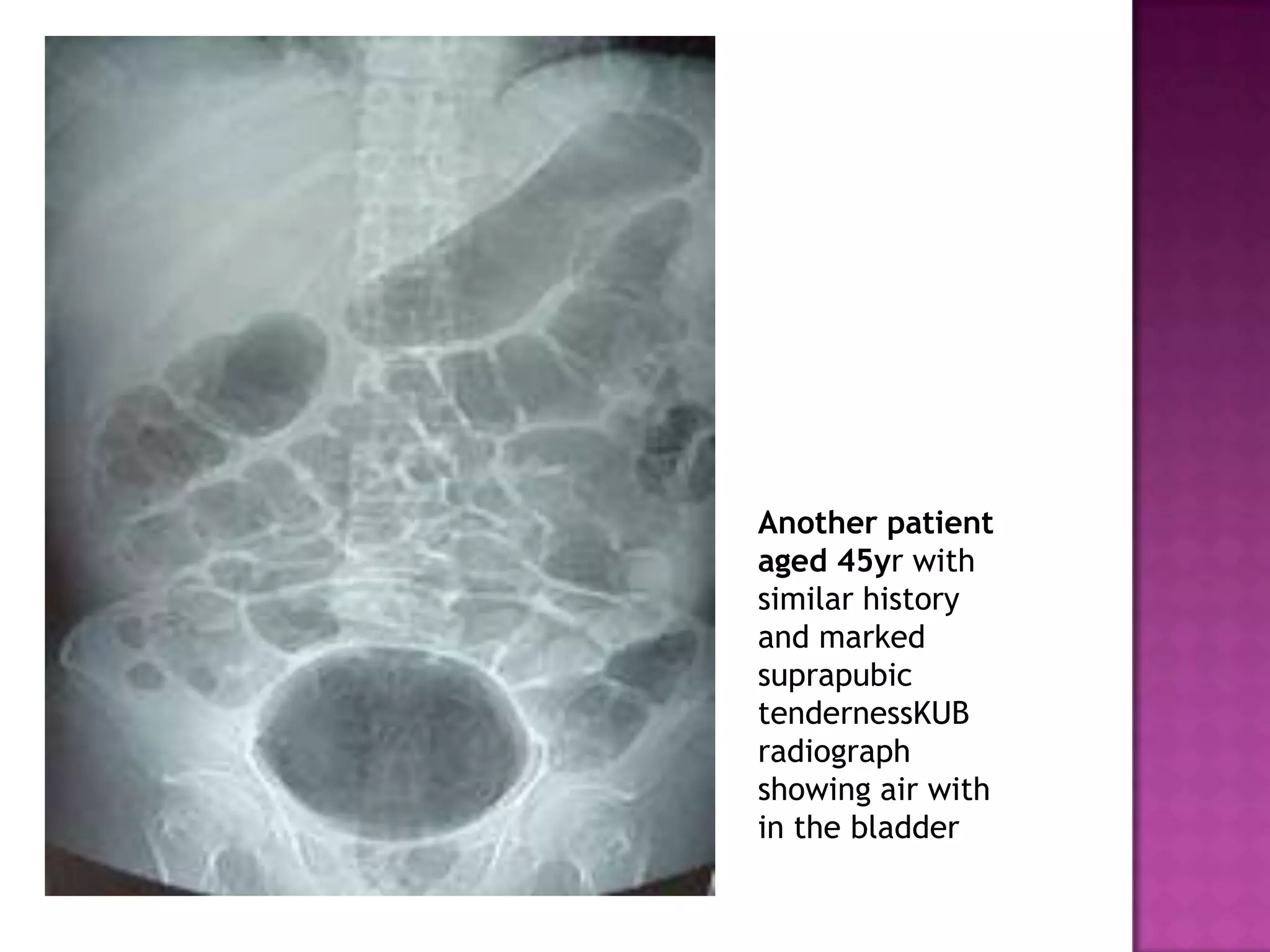 Another patient
aged 45yr with
similar history
and marked
suprapubic
tendernessKUB
radiograph
showing air with
in the bladder
 