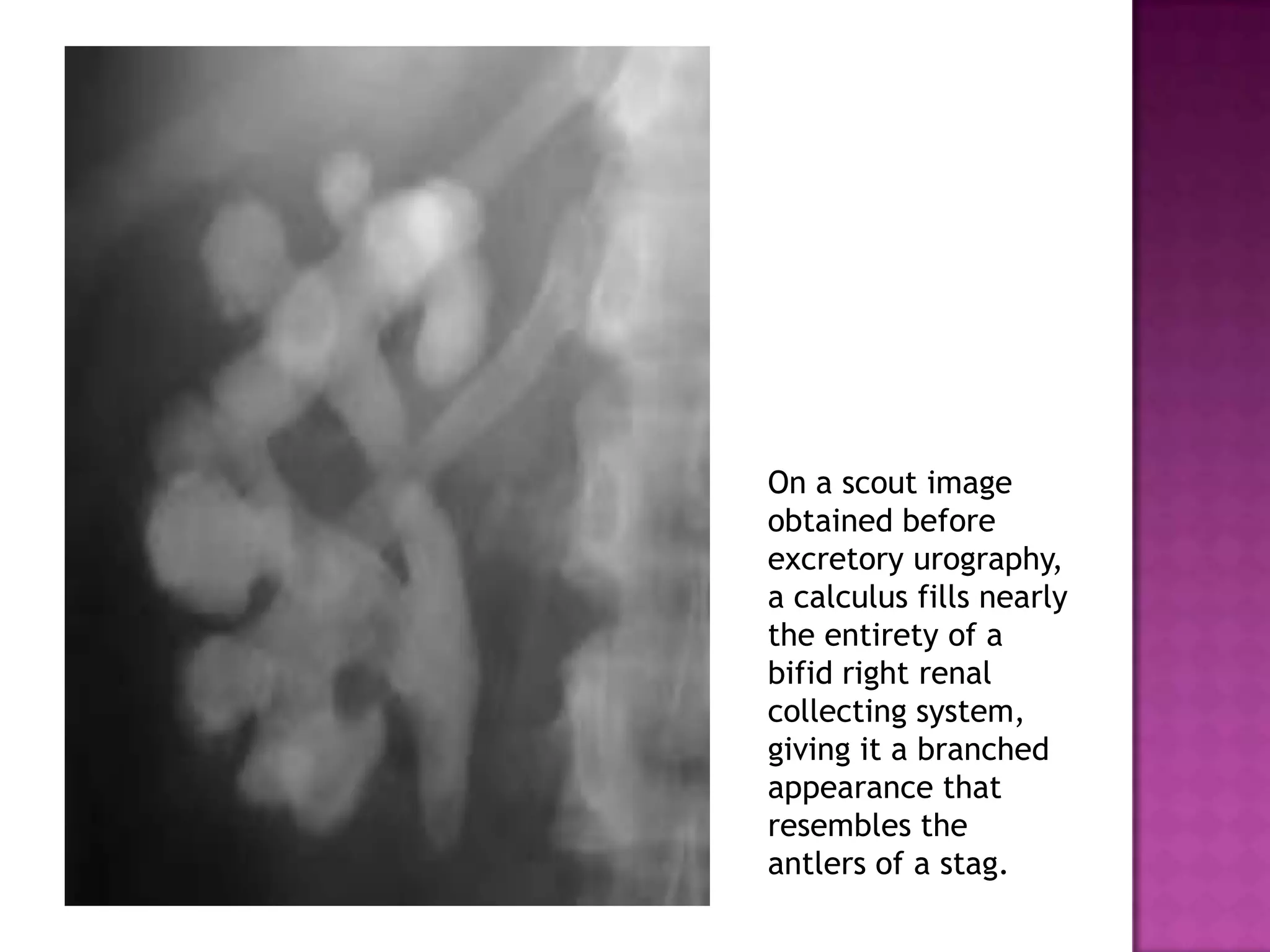On a scout image
obtained before
excretory urography,
a calculus fills nearly
the entirety of a
bifid right renal
collecting system,
giving it a branched
appearance that
resembles the
antlers of a stag.
 