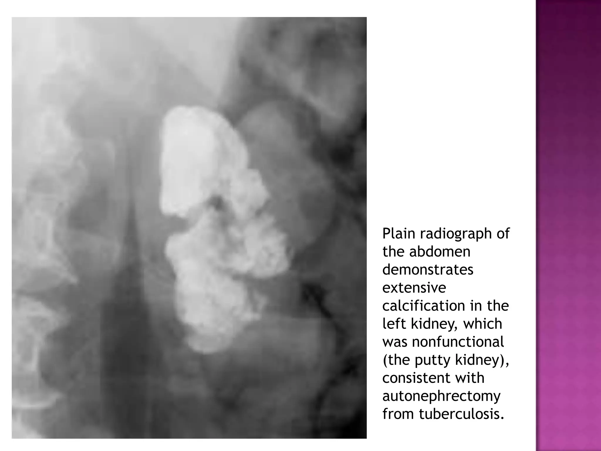 Plain radiograph of
the abdomen
demonstrates
extensive
calcification in the
left kidney, which
was nonfunctional
(the putty kidney),
consistent with
autonephrectomy
from tuberculosis.
 