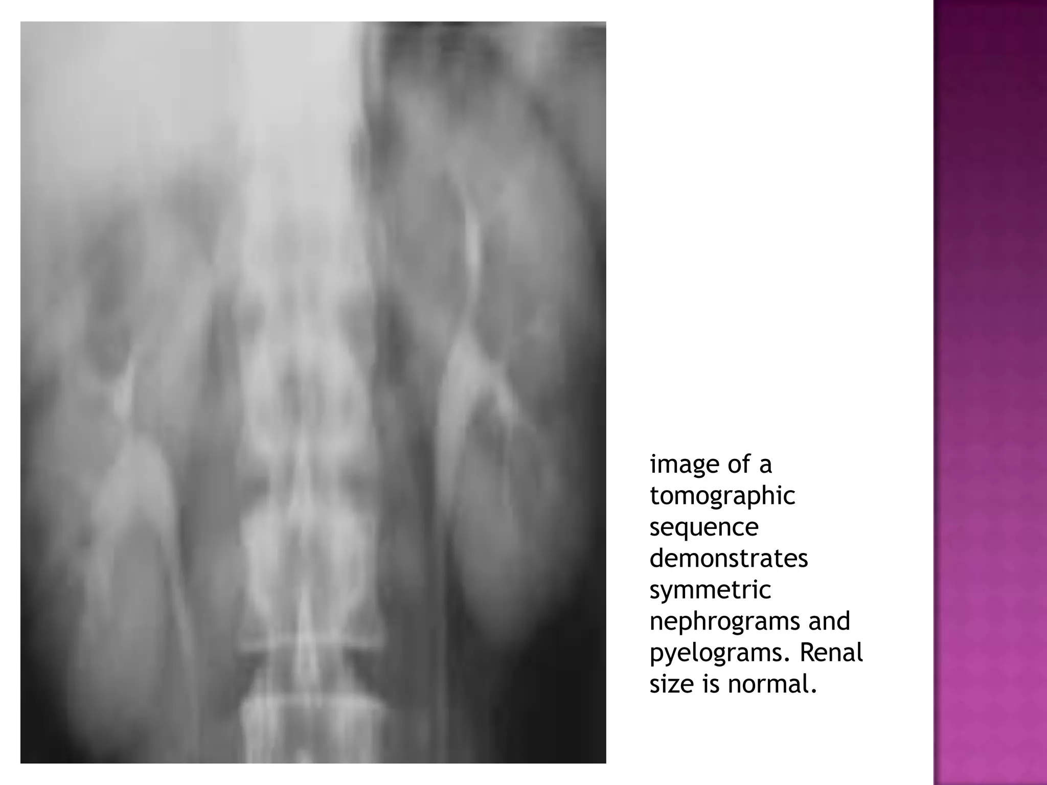 image of a
tomographic
sequence
demonstrates
symmetric
nephrograms and
pyelograms. Renal
size is normal.
 