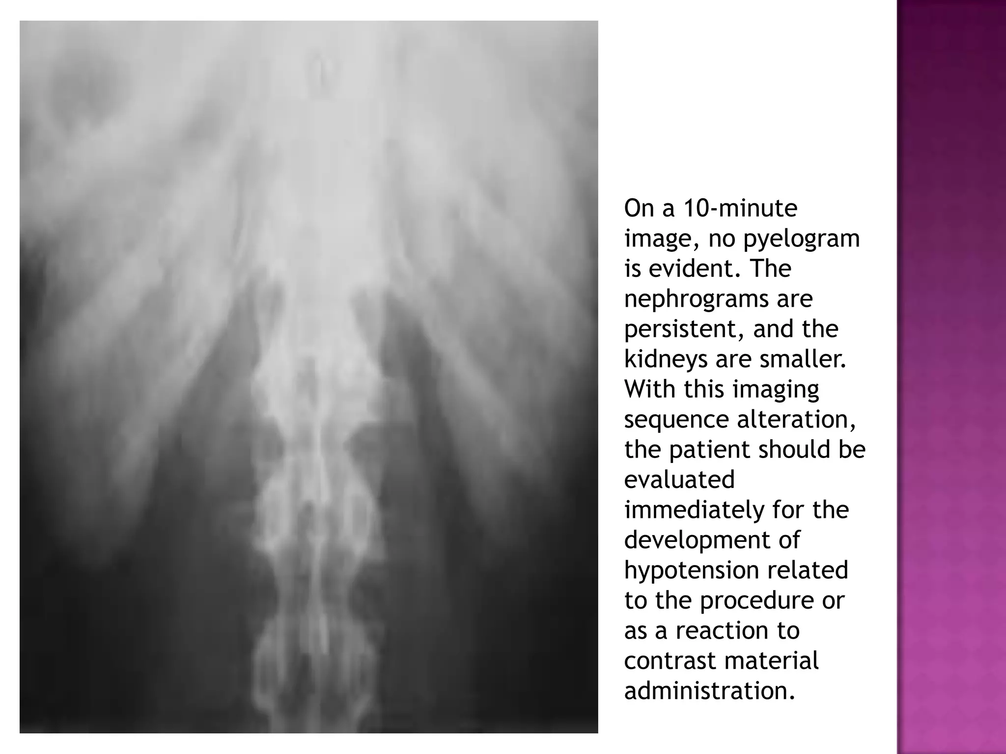 On a 10-minute
image, no pyelogram
is evident. The
nephrograms are
persistent, and the
kidneys are smaller.
With this imaging
sequence alteration,
the patient should be
evaluated
immediately for the
development of
hypotension related
to the procedure or
as a reaction to
contrast material
administration.
 